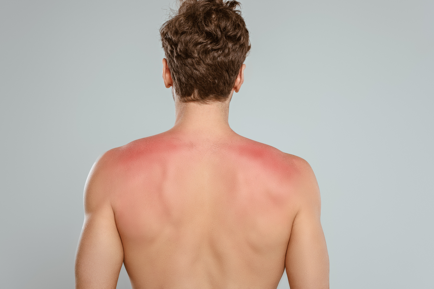 Sunburn